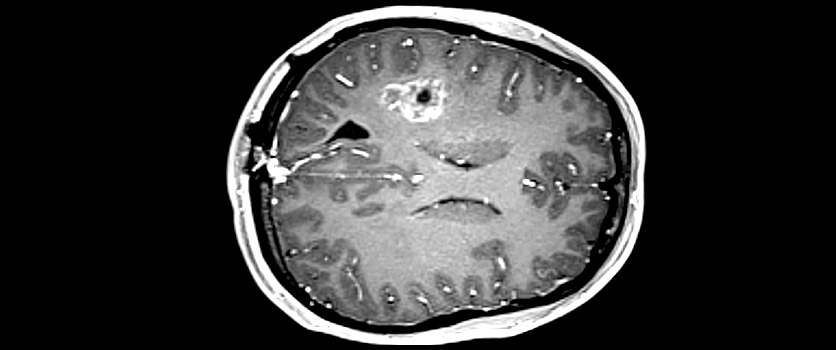 Neurointerventional Radiology Image