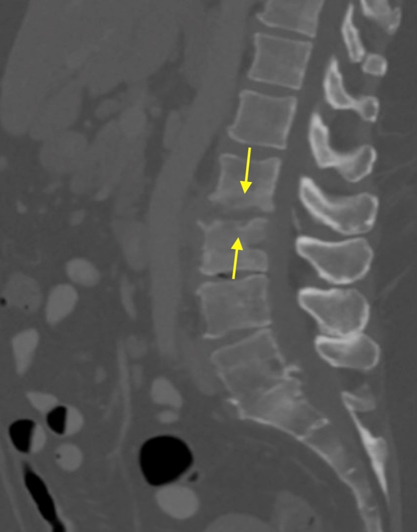 Muscle hernia in a 40-year-old man with a tender palpable mass at