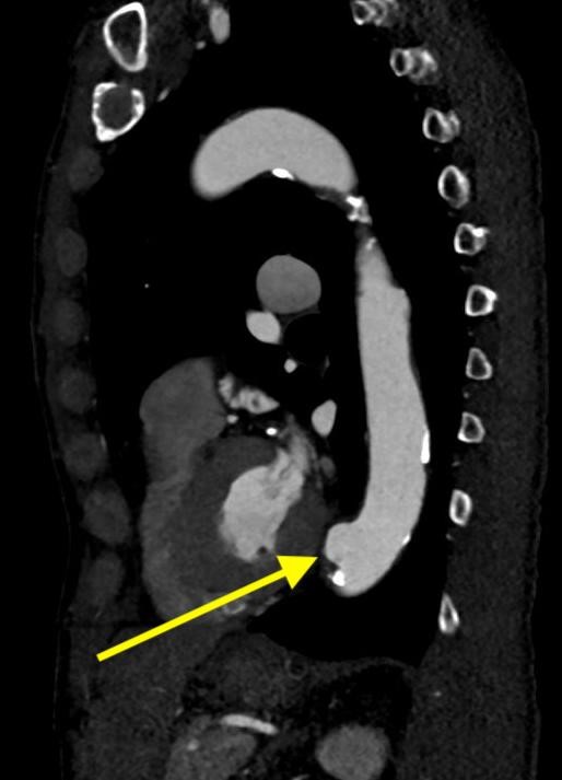 chest-angiogram_1.jpg