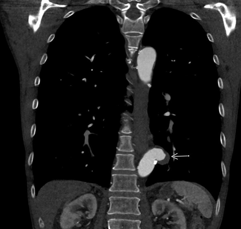 chest-angiogram_3.jpg