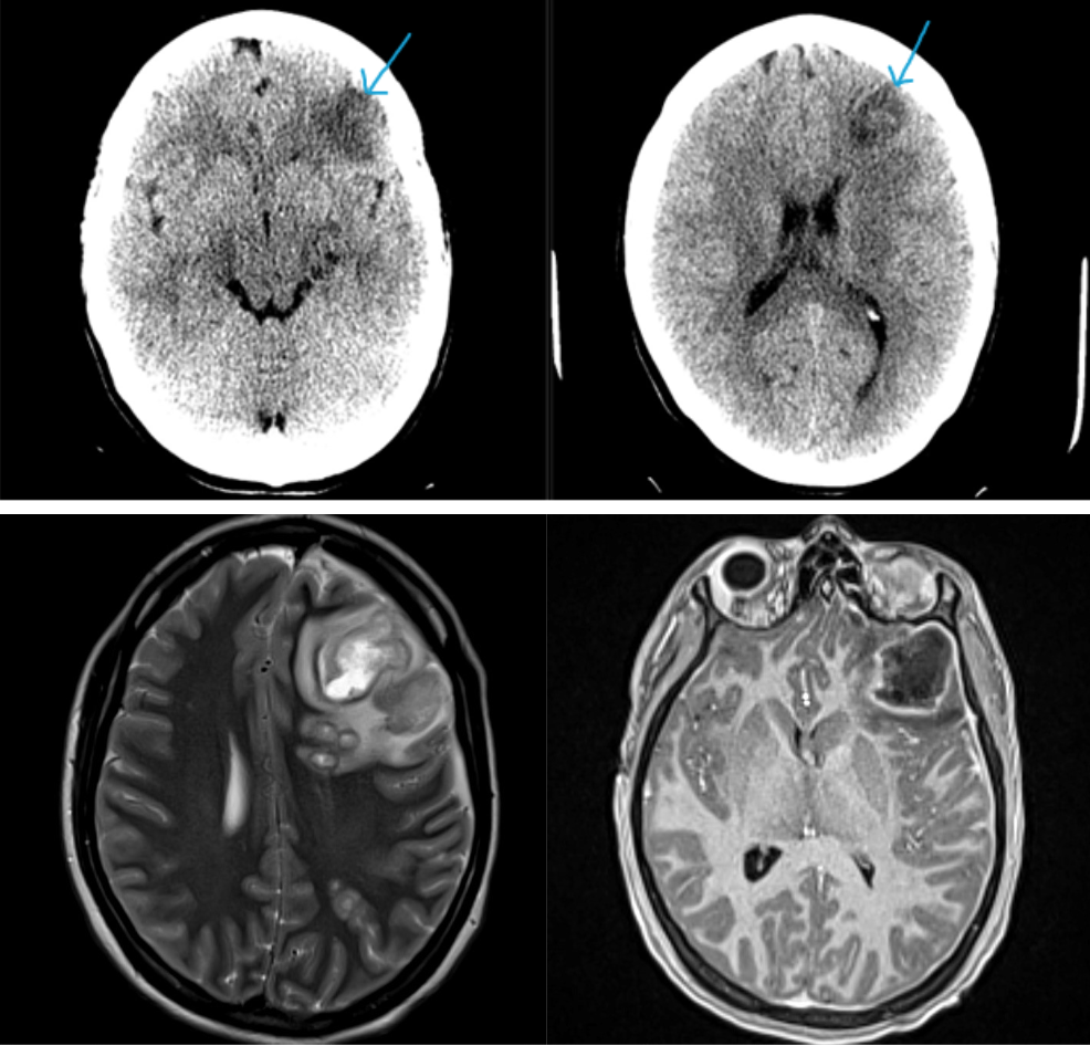 Ring-enhancing cerebral lesions | Cleveland Clinic Journal of Medicine